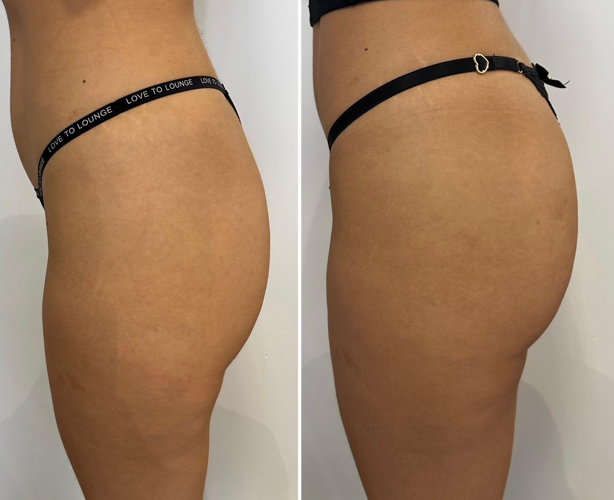 Antes e depois lateral de harmonização glútea