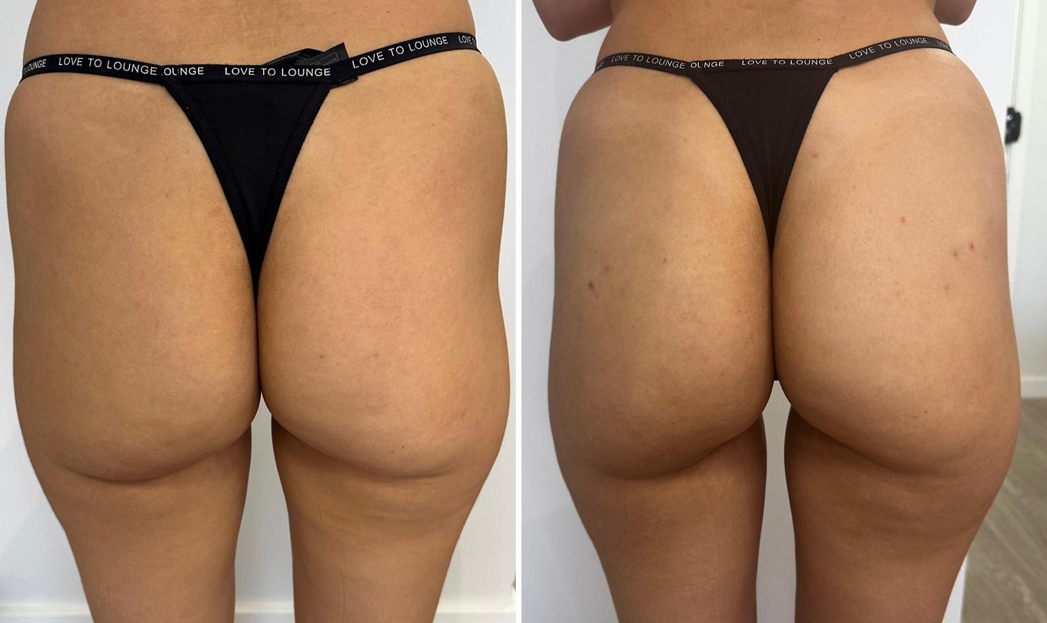 Antes e depois posterior de harmonização glútea
