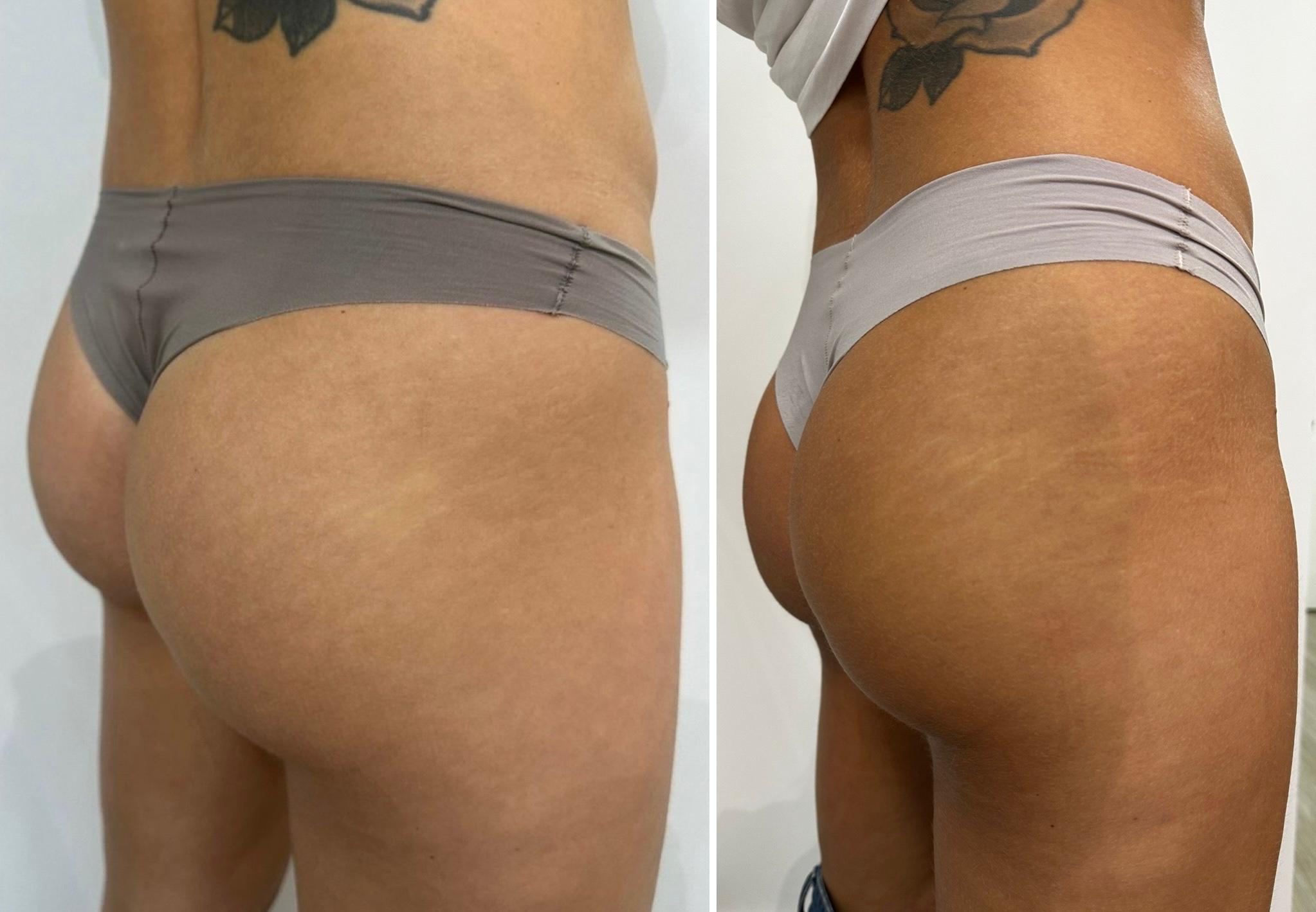 Antes e depois de contorno glúteo