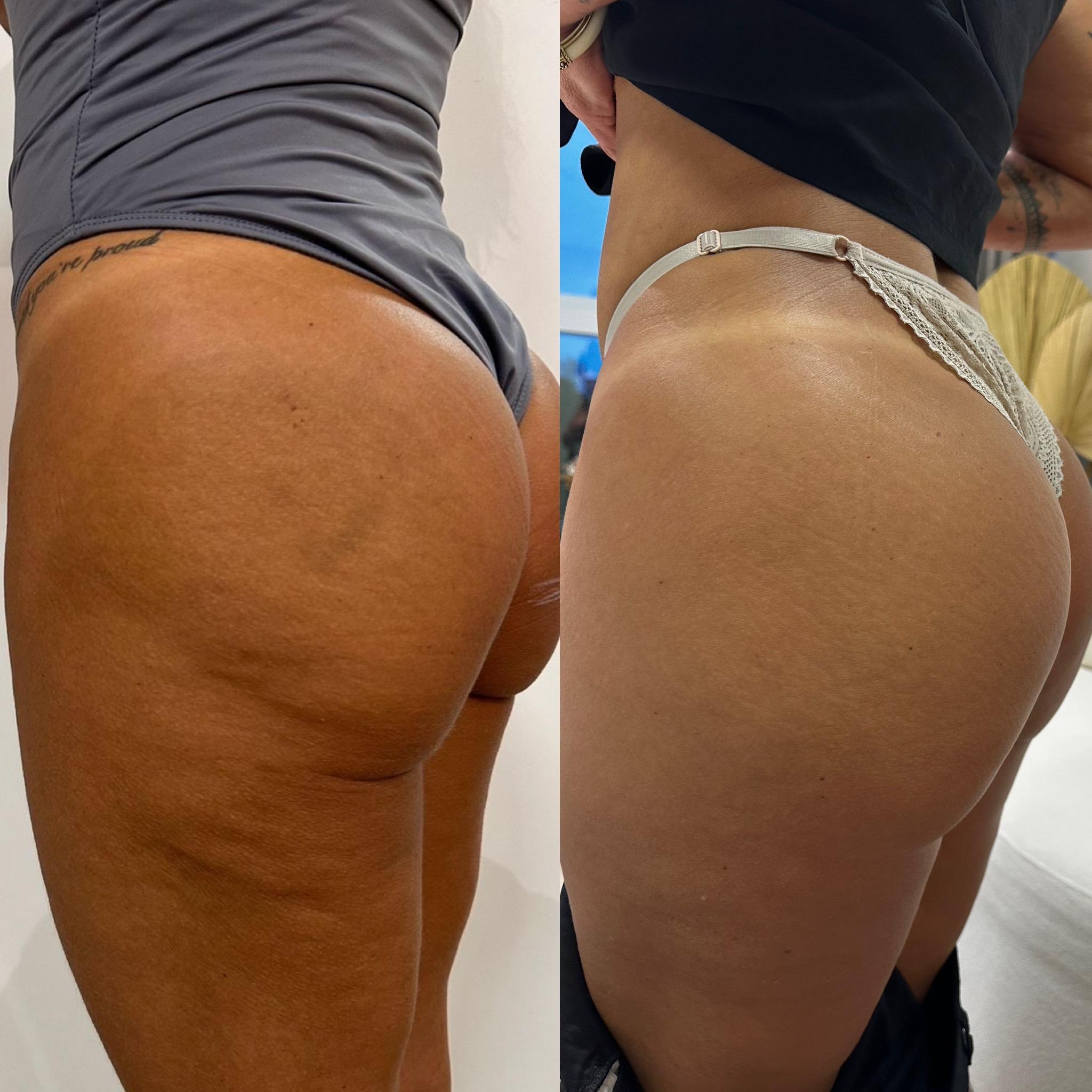 Evolução de qualidade da pele e contorno glúteo